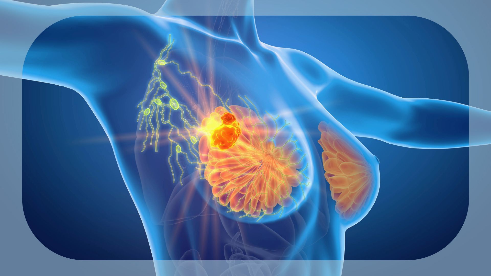 Canada Grants Approval for Ribociclib as Adjuvant Therapy in Early Breast Cancer