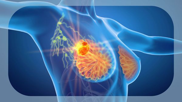 Canada Grants Approval for Ribociclib as Adjuvant Therapy in Early Breast Cancer